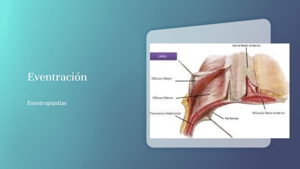 Clase 15: Eventración Y Colocación De Mallas – KMDY