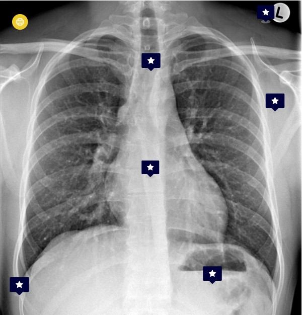 Chest xray anatomy